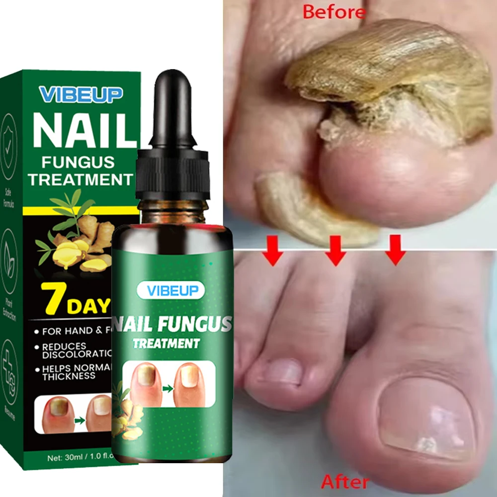 Fungal Nail Treatment Serum 7 Days Foot Nail Fungus Removal Repair Gel Anti Infection Paronychia Onychomycosis Foot Nails Care