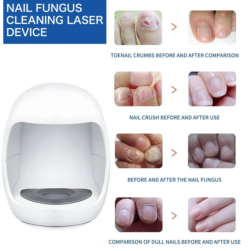 Fungal Nail Treatment Device Repair Fast Nails Fungus Onychomycosis Repair Toenail Fingernail Removes Nail Fungus Foot Care
