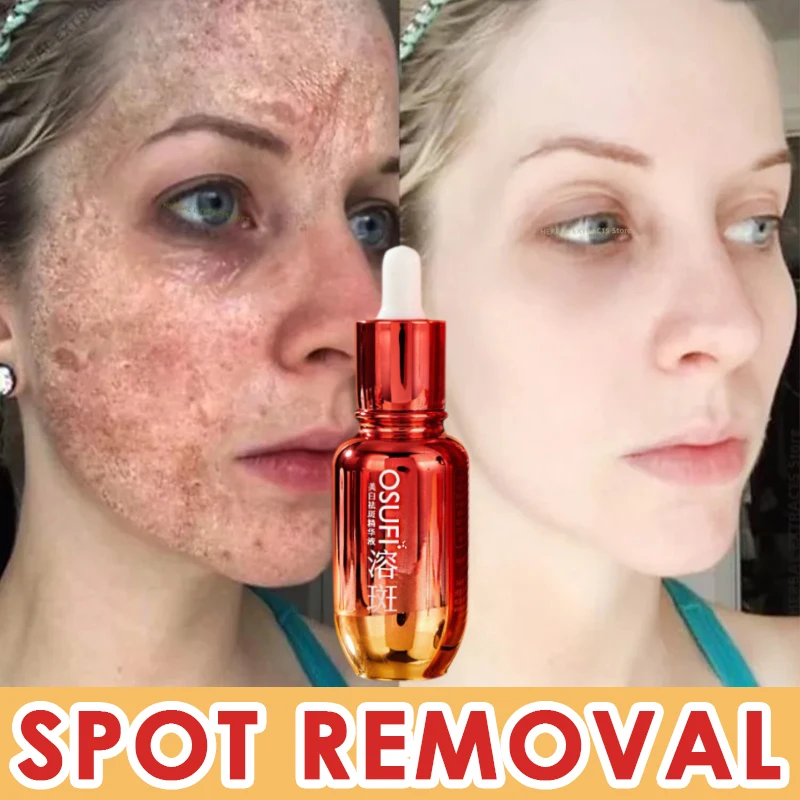 Niacinamida Freckle Removing Serum Lightening Black Spots Melasma Whitening Brightening Evenly Correct Skin Tone Skin Care 50ml lanthome glutathione whitening serum fade black dark spots vitamin c defects reduce facial oil brightening firming for women