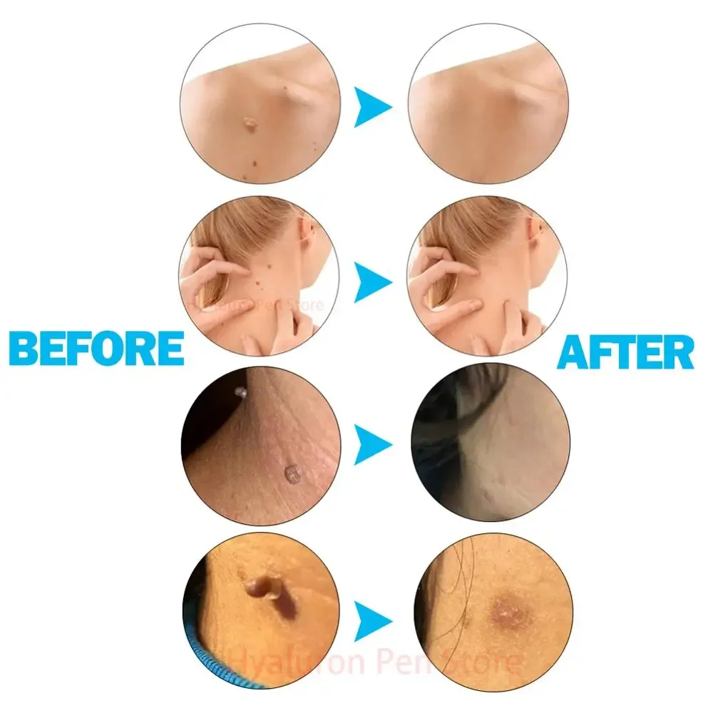 Skin Tag Removal Kit Papilloma Removal Skin Cleansing Band Kit For Remove Berrugas Wart Dots Mole Beauty Appliances