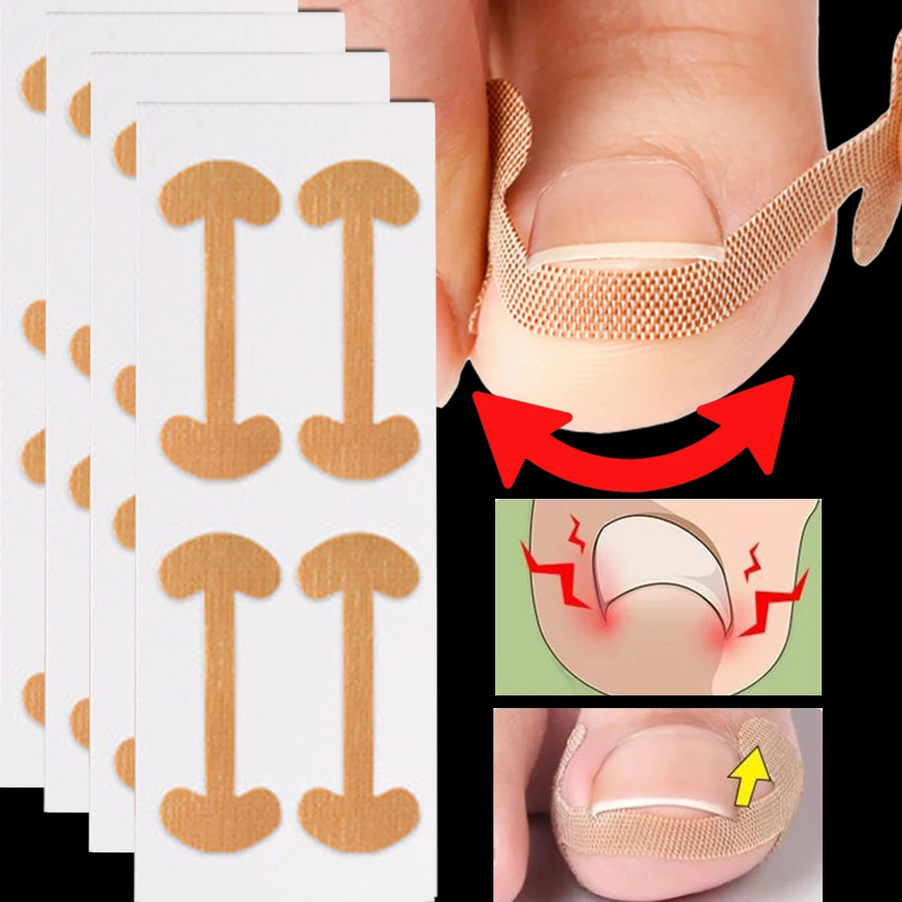 100pcs Nail Correction Stickers Waterproof Ingrown Toenail Correction Strips Anti Infection Nail Treatment Patch Health Toe Care
