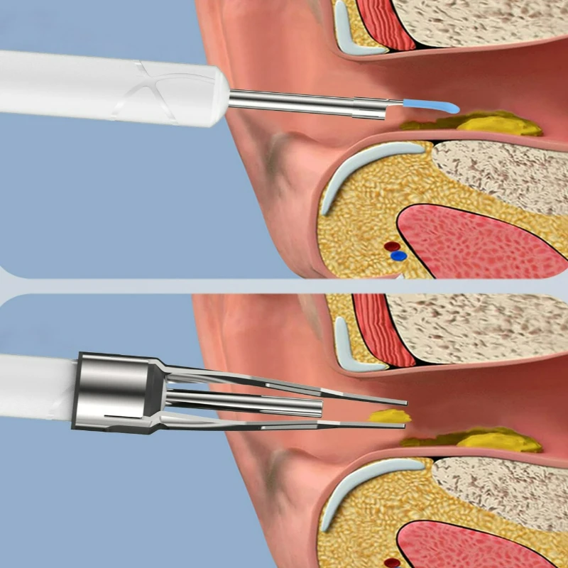 Rechargeable Wireless Ear Wax Removal Kit 5MP Camera Ear Cleaner Check Camera And Ear Spoon Set For Canal Cleaning_voghion.com
