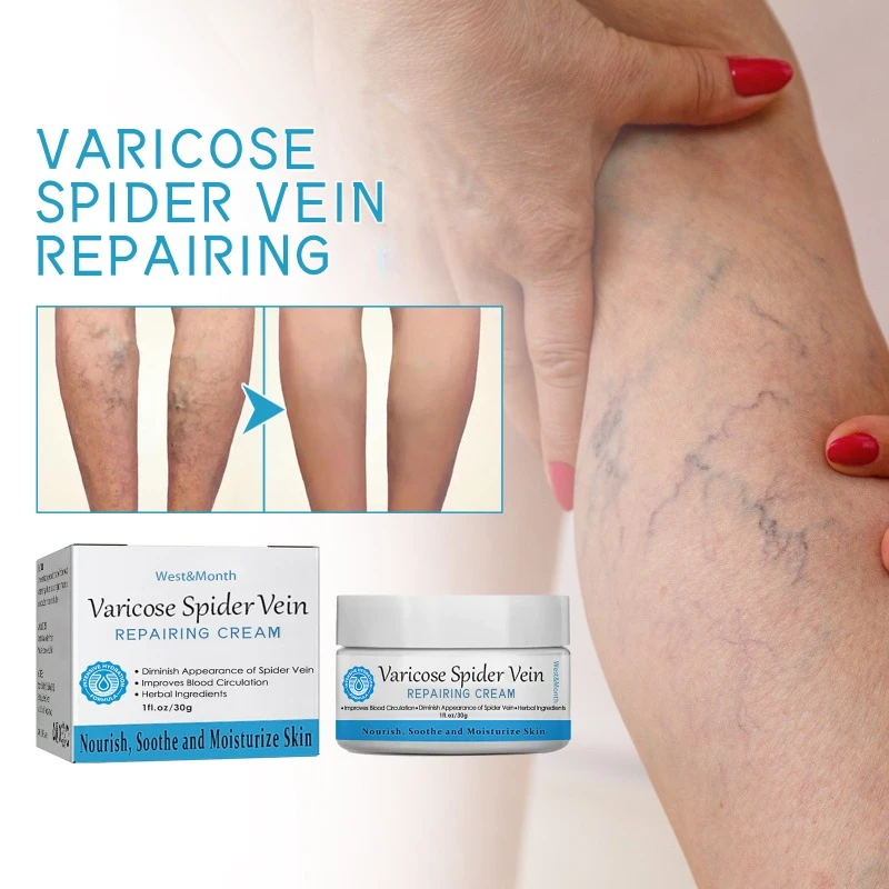 

Spider blood vessels varicose veins Effective varicose vein relief cream to relieve vasculitis phlebitis spider pain treatment