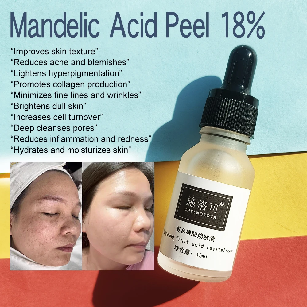 

Almond acid skin tone improvement acne treatment 15ml sensitive skin repair Dull Skin Lackluster Skin Uneven Skin Tone Poor Skin