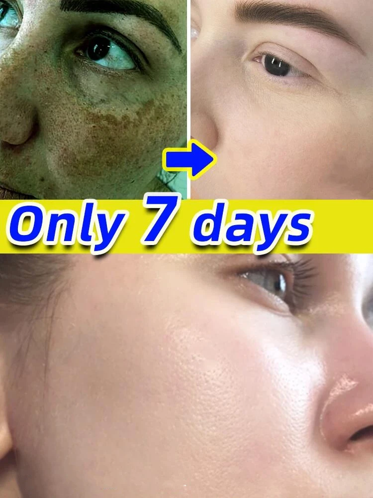 

Dark Spot Remover for Face Removing Freckle Chloasma Senile Plaques Sunburn Cyasma Chorioplaque Freckle Cream Light Dark Spots