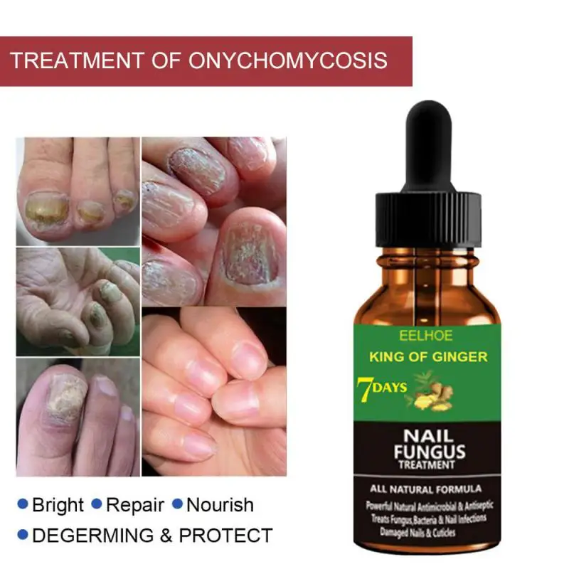 

50ml Ginger Nail Fungal Treatments Feet Care Essencial Anti Infections Paronychia Onychomycosis Foot Toe Nail Care Repair Liquid