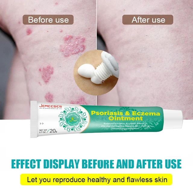 Psoriasis Krém Ekcéma Kenőcs Kezelés Kéz Tinea Pedis Gátolja A Dermatitis Gombaellenes Krémet - Image 6