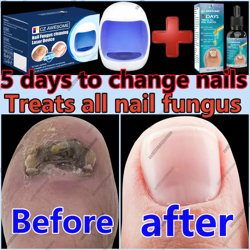Réparation rapide de l\'appareil laser à ongles fongique N64.Fungus Onychomycosis