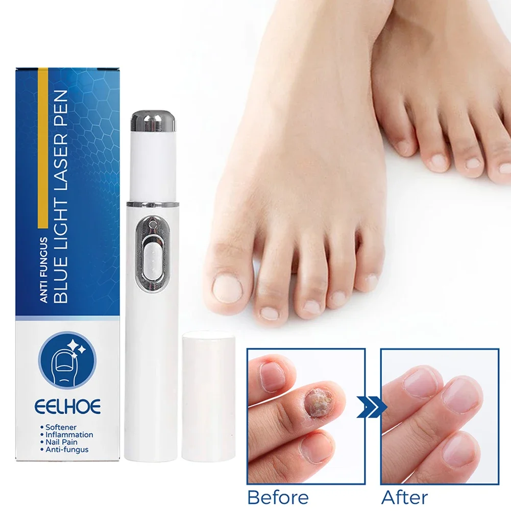 Nail Fungus Treatment Pen Anti-fungal Repair Pen Blue Light Laser Paronychia Nail Onychomycosis Painless Removal Care Tool