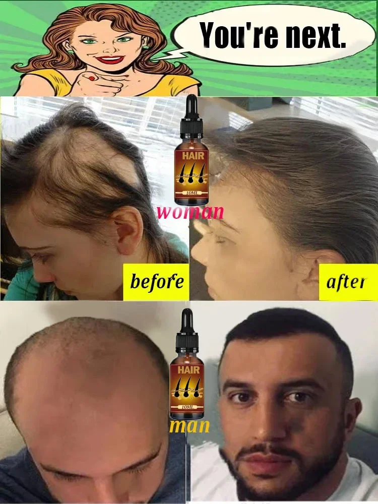 Hot selling product, 99% of buyers buy again, have more and more hair, say goodbye to baldness, thick hair