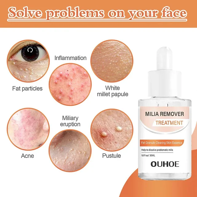 Fat Granules Removal Eye Serum Eye Milia Repair Treatment Products Wrinkle Lifting Moisturizing Anti-Puffiness Korean Skin Care 4
