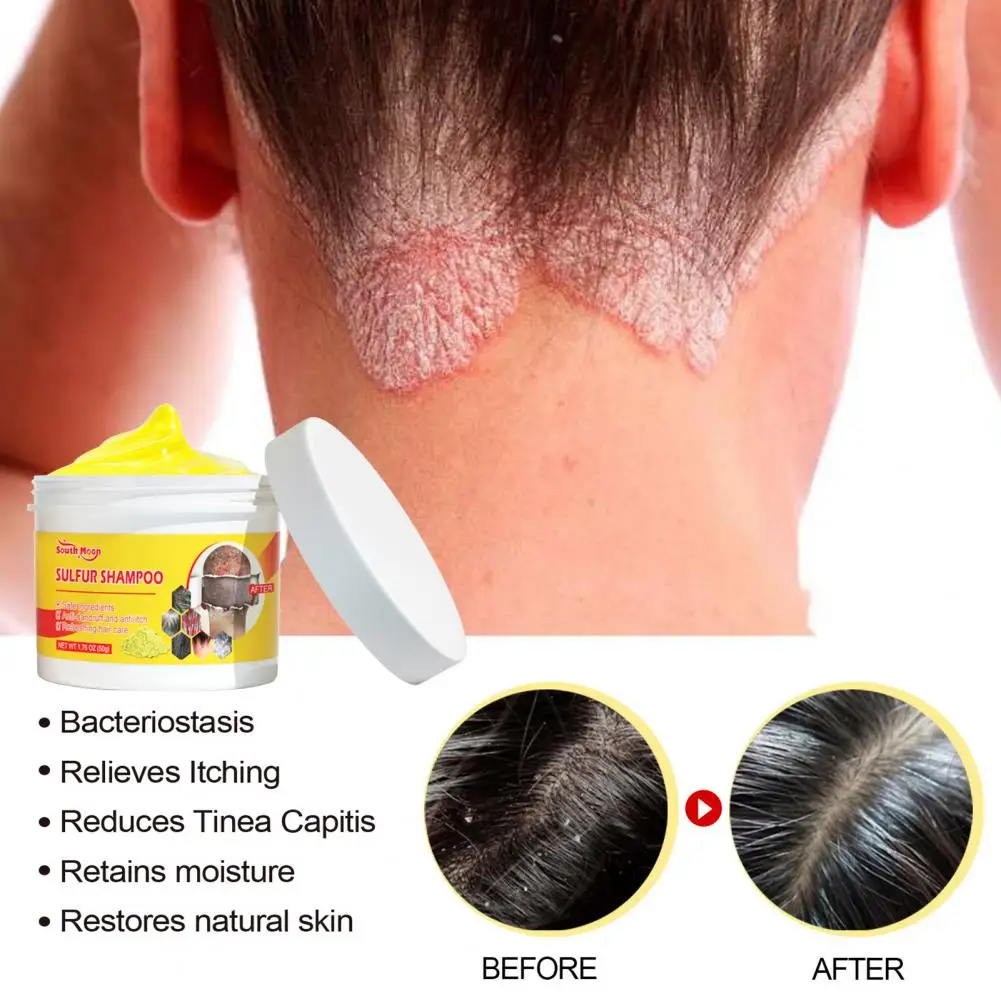 Useful Significant Effect Scalp Treatment Balm Anti-itching Scalp Shampoo Against Itchy Relief Shampoo Oil Control pet ear wet wipes ear dirt odor removal mite itching relief canal deodorant earwax cleaning against infection dog ear wet towels