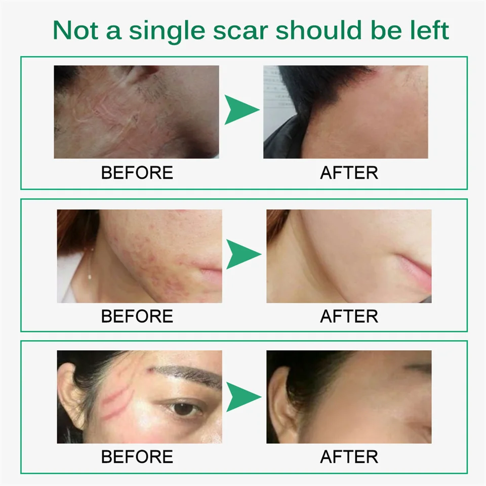 Herbal Scar Removal Cream