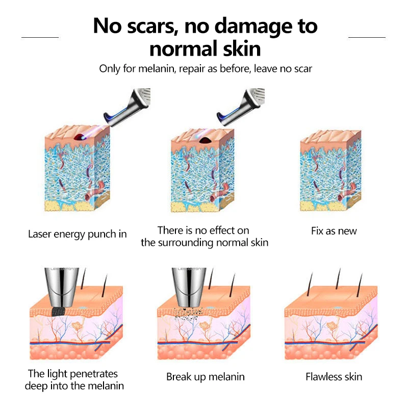 Laser Skin Treatment Picosecond Laser Pointer Mole Dark Spot Acne