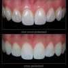 Dental Cross Polarization Kit For Godox MF12 Camera Flash - No Reflections, No Glare Camera Photo Kit Polar Eye For Dentist 2