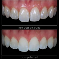 Dental Cross Polarization Kit For Godox MF12 Camera Flash - No Reflections, No Glare Camera Photo Kit Polar Eye For Dentist 2