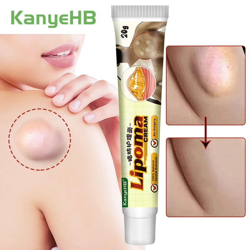Pain relief cream,skin care ointment 1Pcs Lipoma Removal Cream Relief Pain Skin Swelling Lipolysis Cellulite Fat Lump Nodule Removal Ointment Anti-tumor Plaster G040