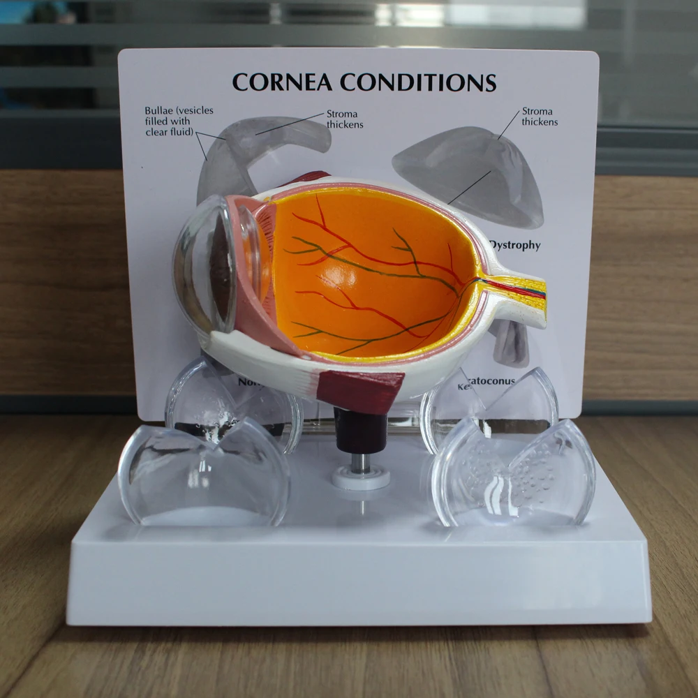 Cornea Eyeball Model Human Eye Demonstration Glaucoma Cataract Anatomy Medical Teaching Tool