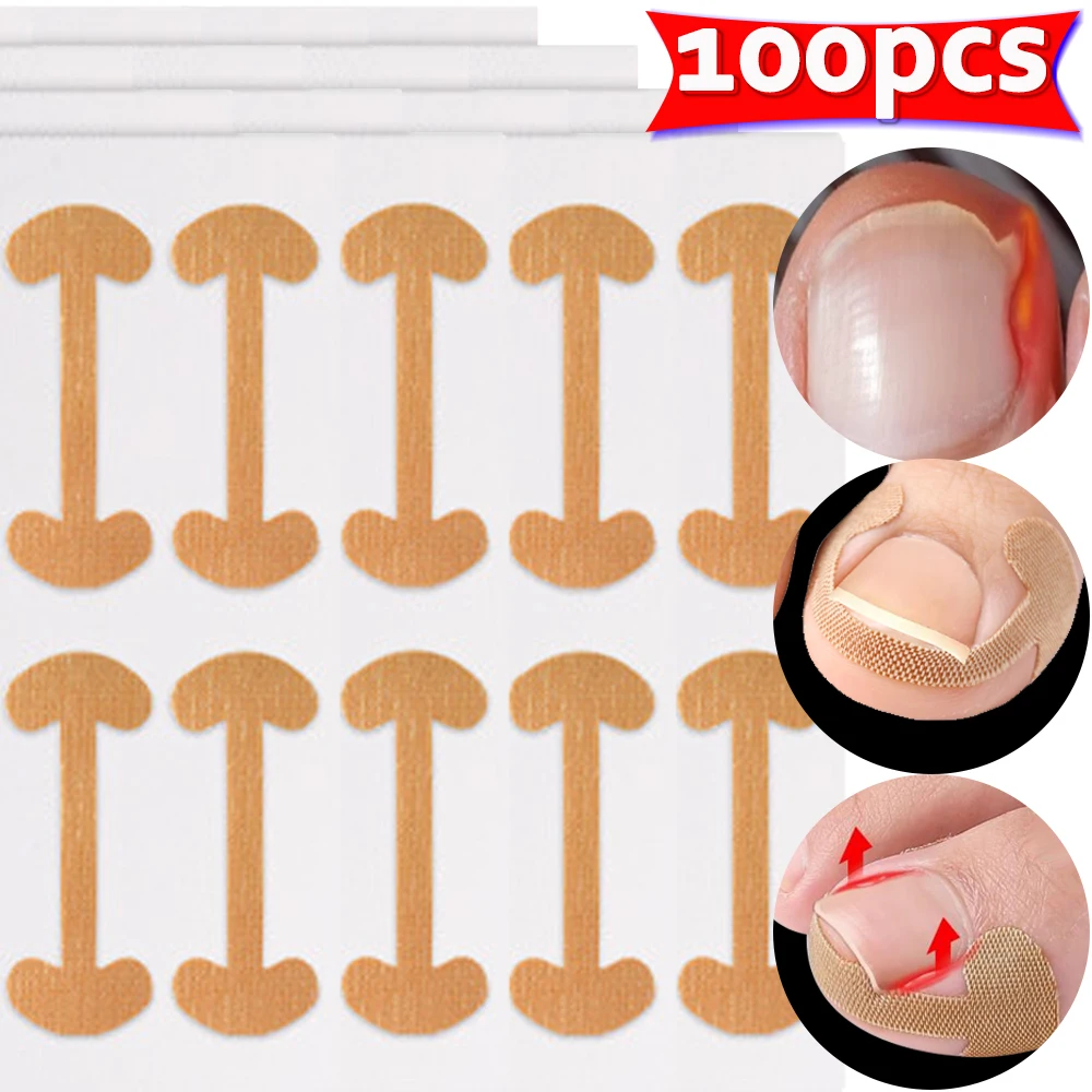 Ingrown Toenail Correction Strips Lasting Adhesion Waterproof Nail Correction Stickers Elasticity Toe Care Pedicure Tools 100pcs