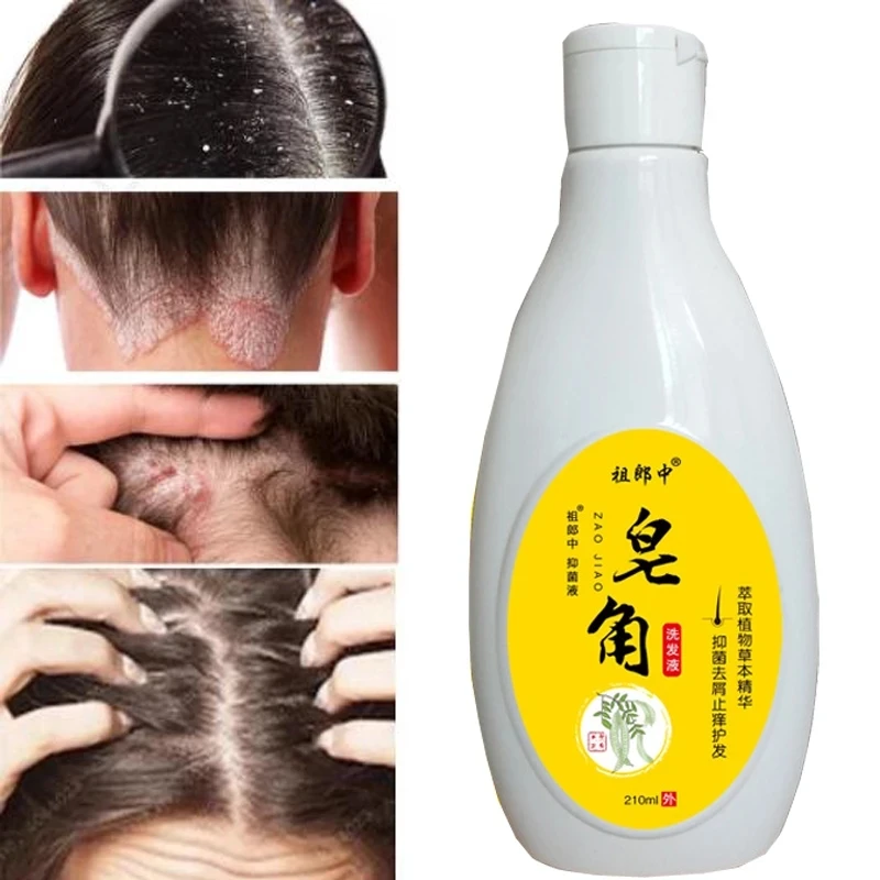 210ml Scalp Cleansing Dandruff Seborrheic Follicles Antibacterial Mites Oil Psoriasis Removal Acne _ - AliExpress