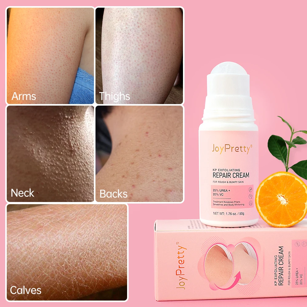 JoyPretty Chicken Remover Skin Care Body Cream Keratosis Pilaris Treatment Skin Repair Body Lotion Moisturizing Whiten Body Care 2