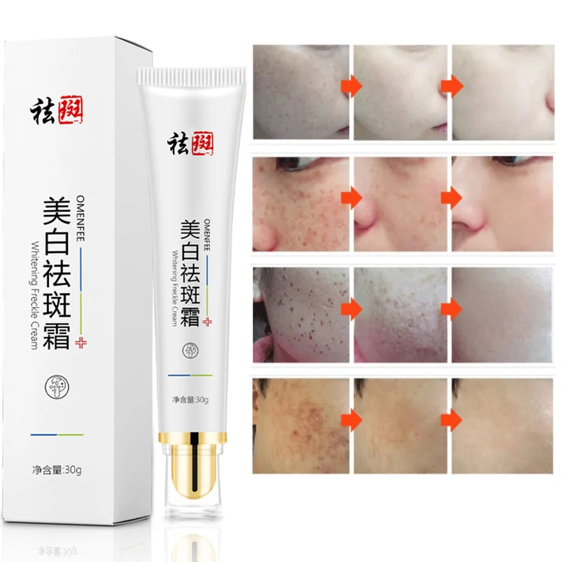 

Effective Whitening Freckle Cream Remove Melasma Acne Spot Pigment Melanin Dark Spots Pigmentation Moisturizing Gel Skin Care
