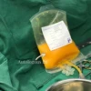 10-pcs Lot Pack Single Use 200ml Medical PVC Storage Bag for Autologou Fat/Autologous fat transfer 2