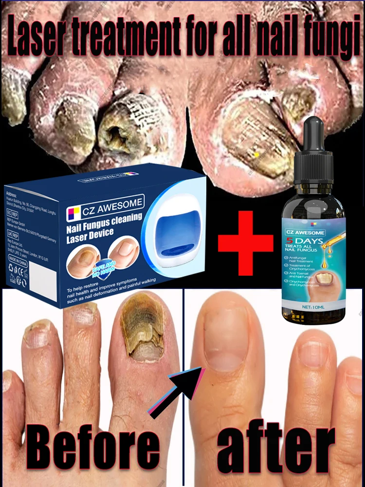 Fungus Nail Laser Device Repairs Fast Nail Fungus