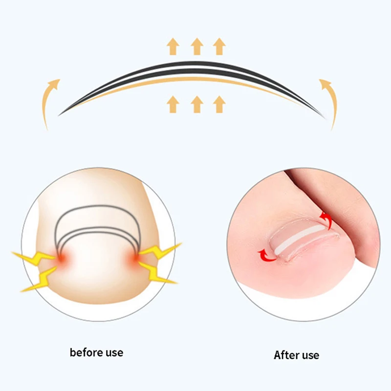 alt="The 10pcs Ingrown Toe Nail Treatment, an Elastic Patch Sticker and Pedicure Tools set.
