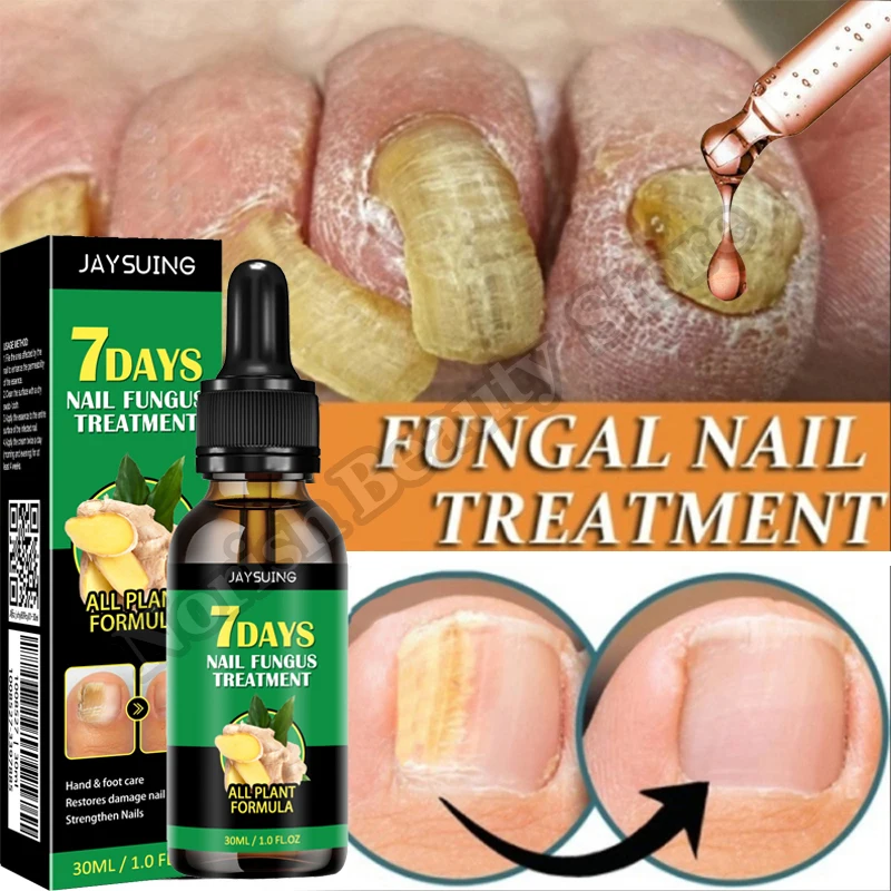 

7 Days Nail fungal Treatment Serum Foot Fungus Remedy Removal Products Anti Infection Onychomycosis Paronychia Repair Gel Care