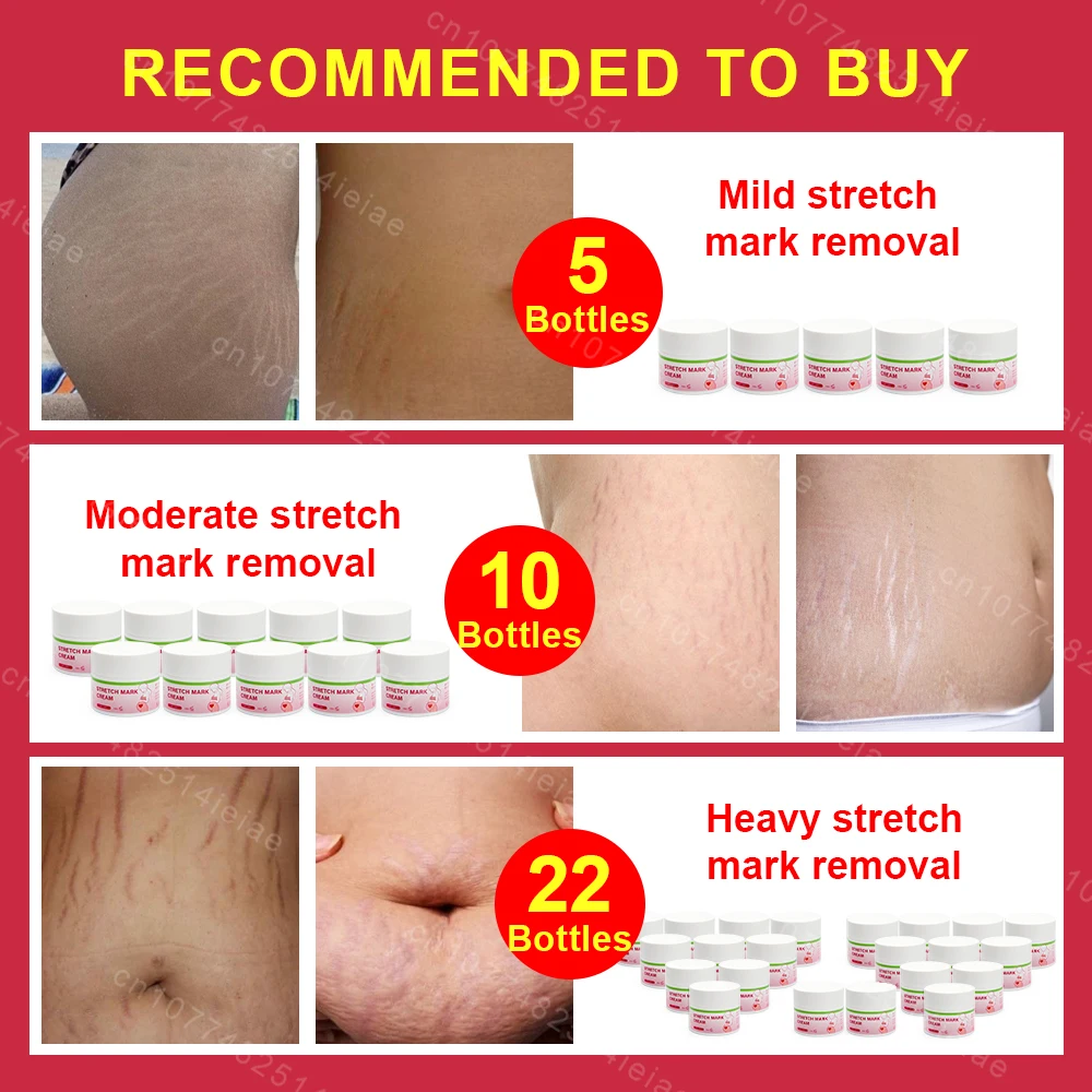 Pregnancy Mark Removal Cream Permanent Repairs Damaged Skin Natural Ingredients Remove Abdominal Pregnancy Line Without Stains