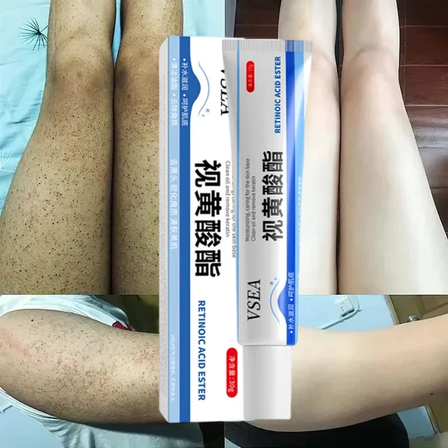 Keratosis Pilaris Cream – Smooth, Clear & Soft Skin