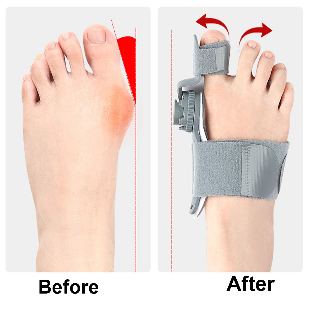 Adjustable Bunion Corrector Toe Separator Hallux Valgus Foot Corrector Toe Separator Straightener Pedicure Finger