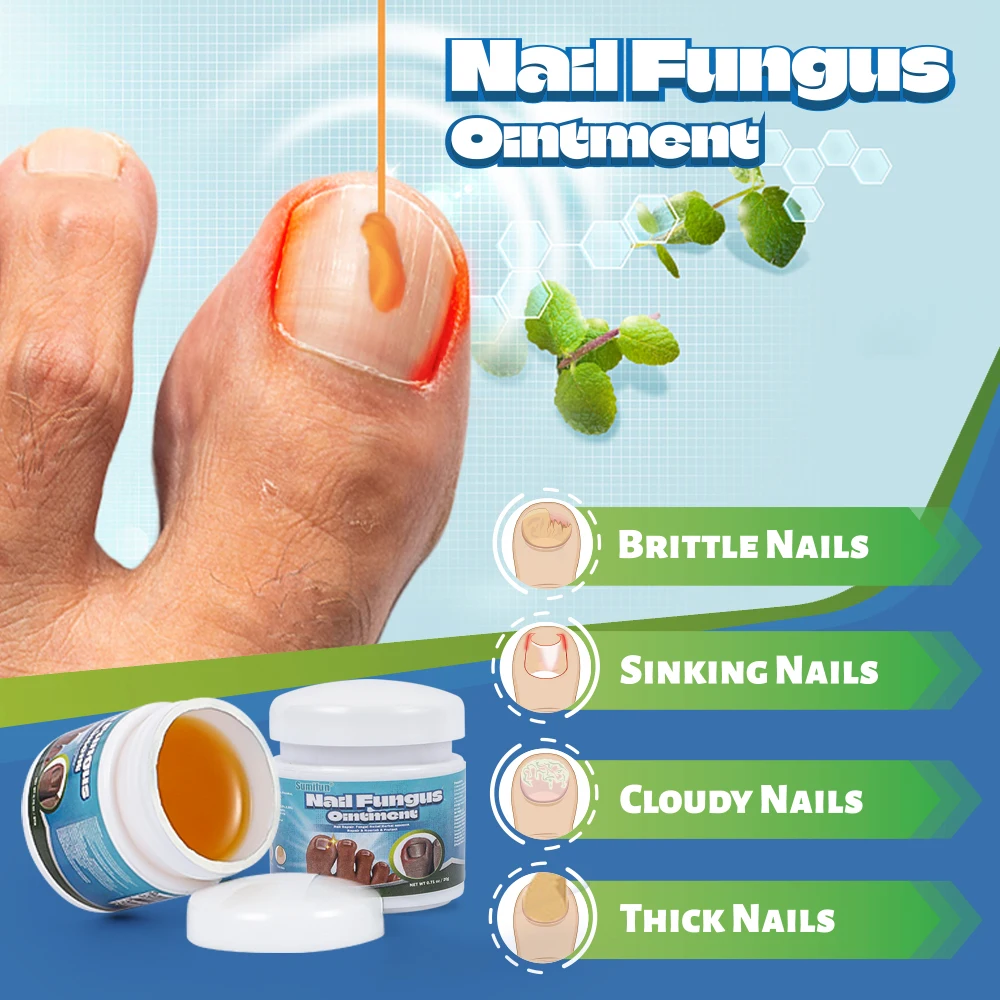 20G/box Sumifun Nail Fungus Treatment Cream Herbal Extract Paronychia Onychomycosis Repair Ointment Anti Infection Foot Care antibacterial anti fungal cream,nail fungus treatment patches