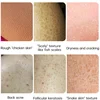 Body Whitening Cream Keratosis Pilaris Treatment Bumpy Rough Chicken Follicle Skin Repair Strawberry Legs Removal Dry Skin Care