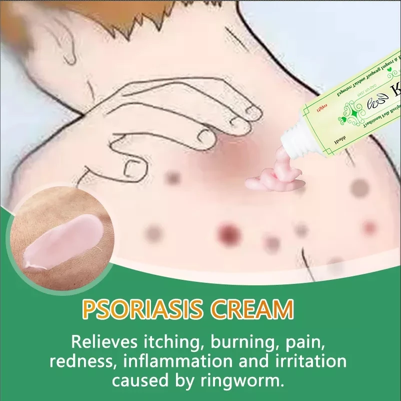 Psoriasis Ointment YIGANERJING RAEL Original Powerful Professional 5Pcs Native Medicine Ingredient Security