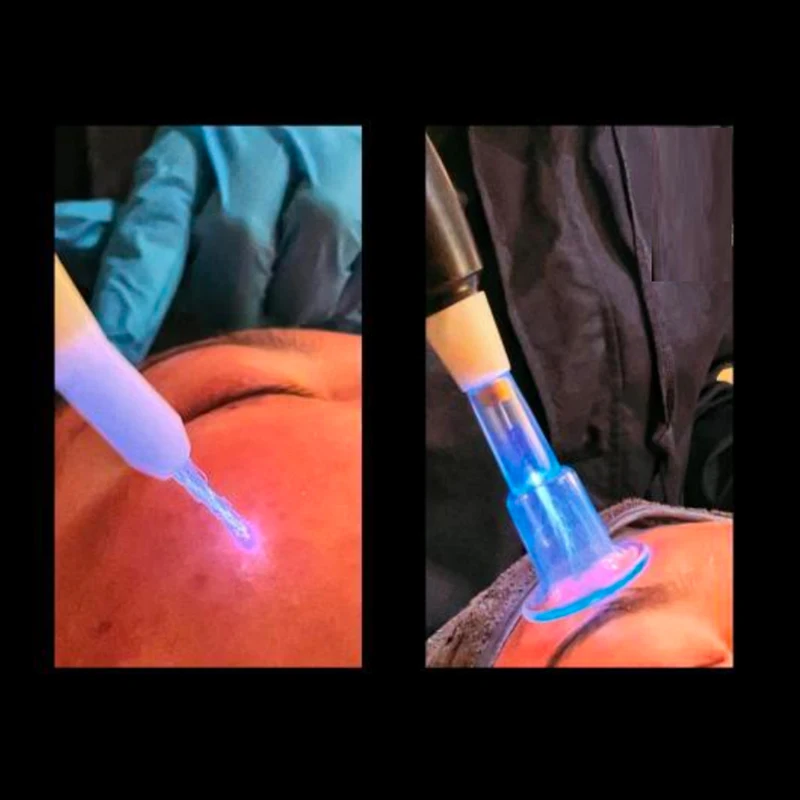 High Tech Cold Fusion Plasma Skin Tightening Wrinkle Removal Lifting Jet Fusion Plasma Pen Warm Equipment