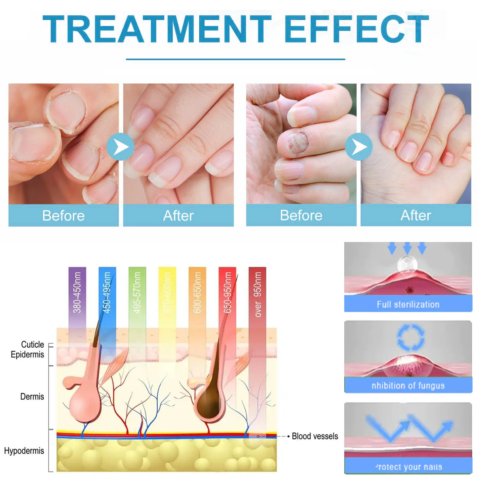 Laser Nail Fungus Treatment Device Repair Ingrown Toenail Fingernail Fungus Corrector Podiatry Mold Laser Nails with Mushrooms