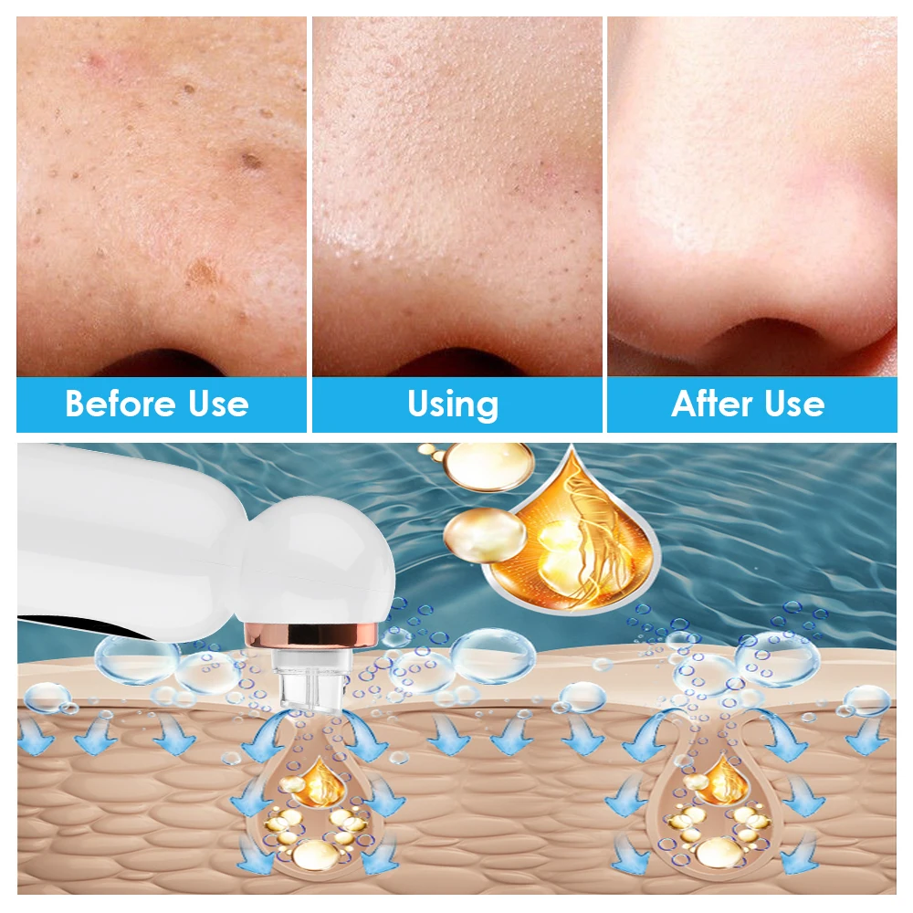 Blackhead Remover Vacuum Suction 2
