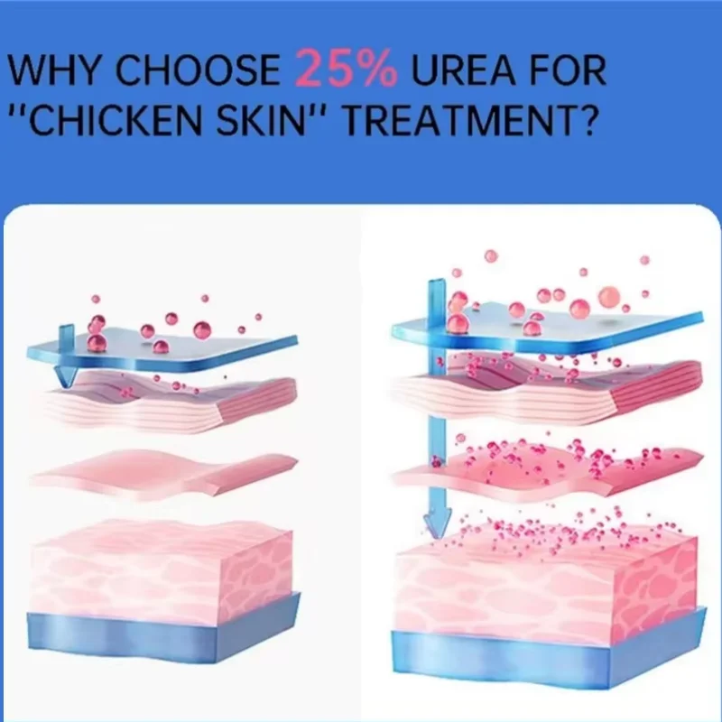 Curing Keratosis Pilaris Chicken Follicle Skin Repair Cream Body Dark Spot Remove Whiten Smooth Moisturize Skincare Body Lotion whitening body cream whitening cream body lotion brightening cream body care brightening body cream body skin care cream