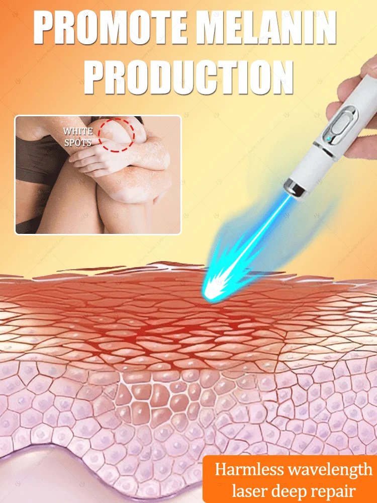 2세대 업그레이드된 백반증 치료제 ? 백반증 치료 ? 빠르게
