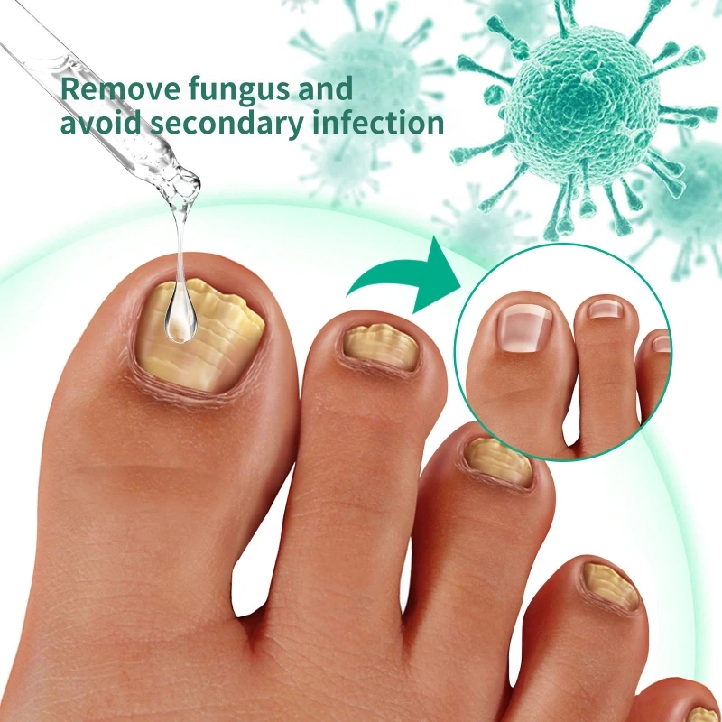 

Nail for Toe and Fingernail Anti-Fungal Nail Repair Liquid Renew Damaged Discolored Nails & Toenails