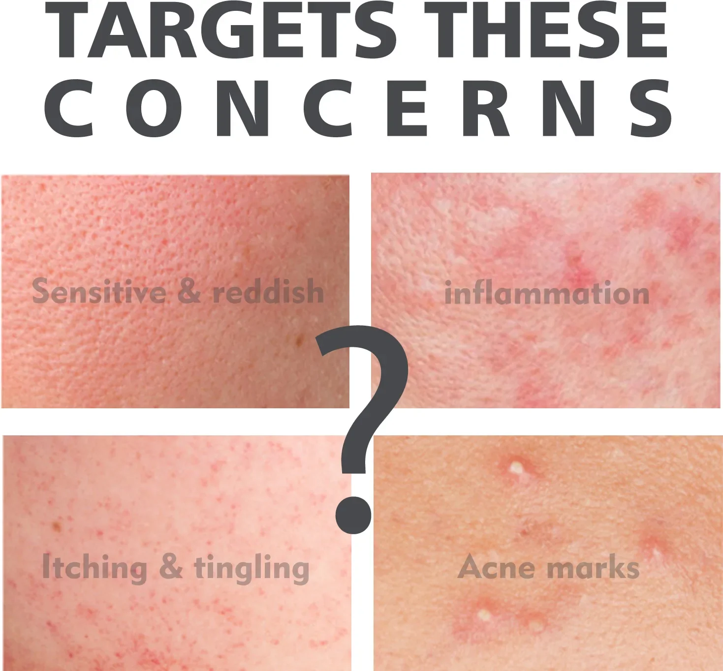 Tratamento de acne soro comum ácido salicílico soros remover espinhas cravos anti acne poros encolher essência de rejuvenescimento da pele_voghion.com