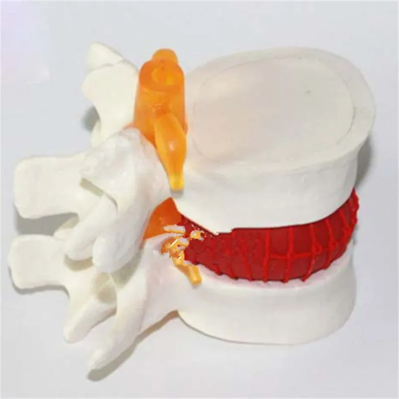 Human Lumbar Disc Herniation Model Demonstration Model of Lumbar Vertebral Spine Model Medical Teaching Resources