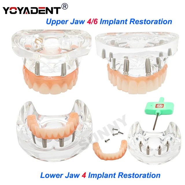 Maryland Bridge Dental Implant Teeth Model Transparent Upper/Lower Jaw Type Overdenture Modle With 4/6 Removable Implant Screws