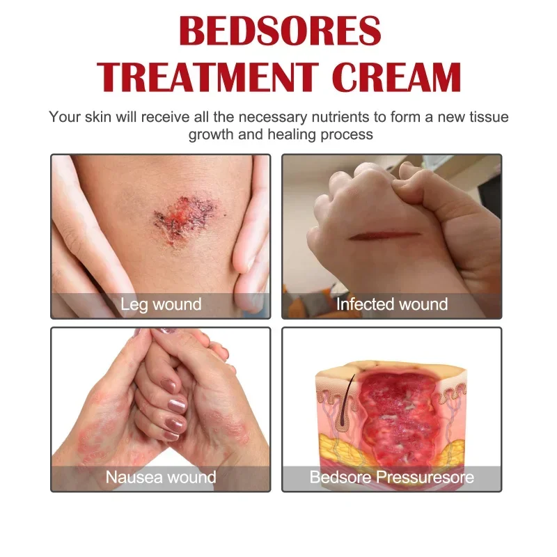 Decubitus Cream Pressure Sore Ulcer Skin Relief Ointment Bed Sore Wound Healing Treat Anti Dry Repair Moisturizing Body Care sore healing cream