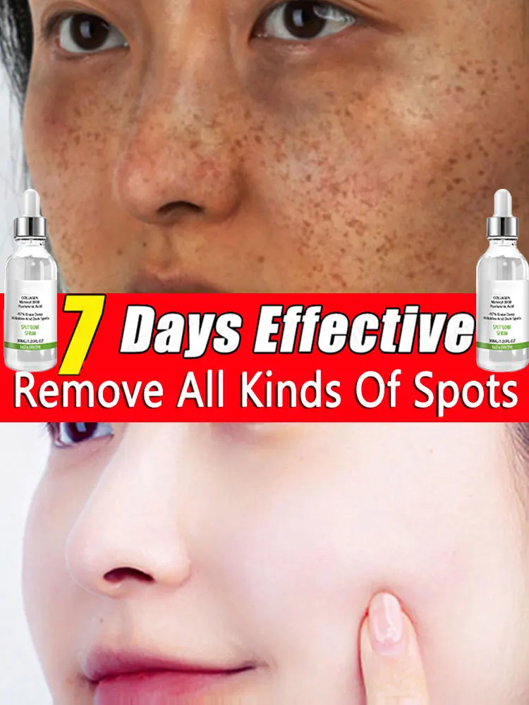 

Anti-spot Remove freckles, chloasma, dark spots, hyperpigmentation, age spots, sun spots, whitening light spots