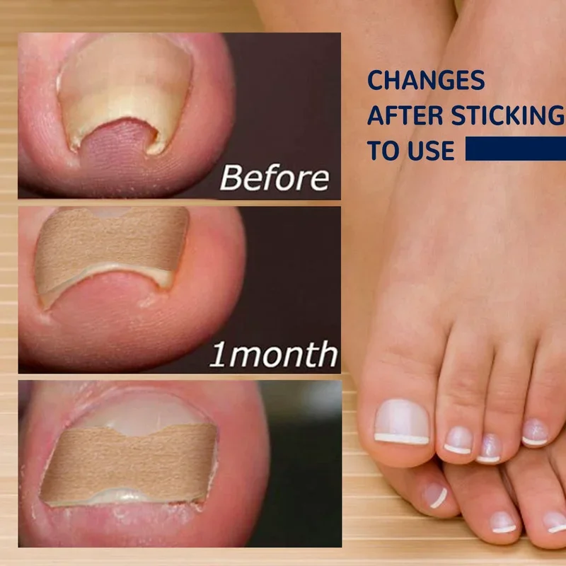 50PCS Ingrown Toenail Correction Tool, Waterproof Nail Correction Stickers for Paronychia Treatment