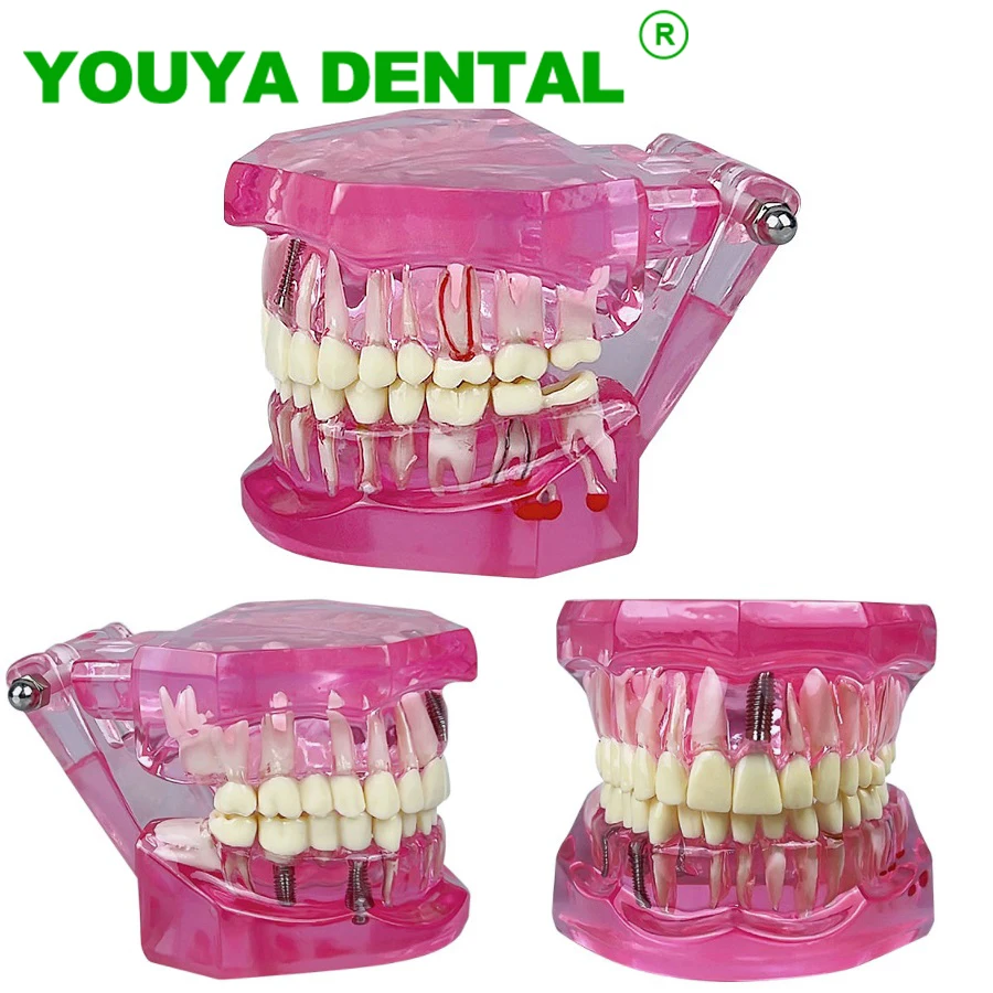 

Dental Implant Teeth Repair Model With Restoration Bridge Teaching Study Medical Science Disease Dentist Dentistry Products