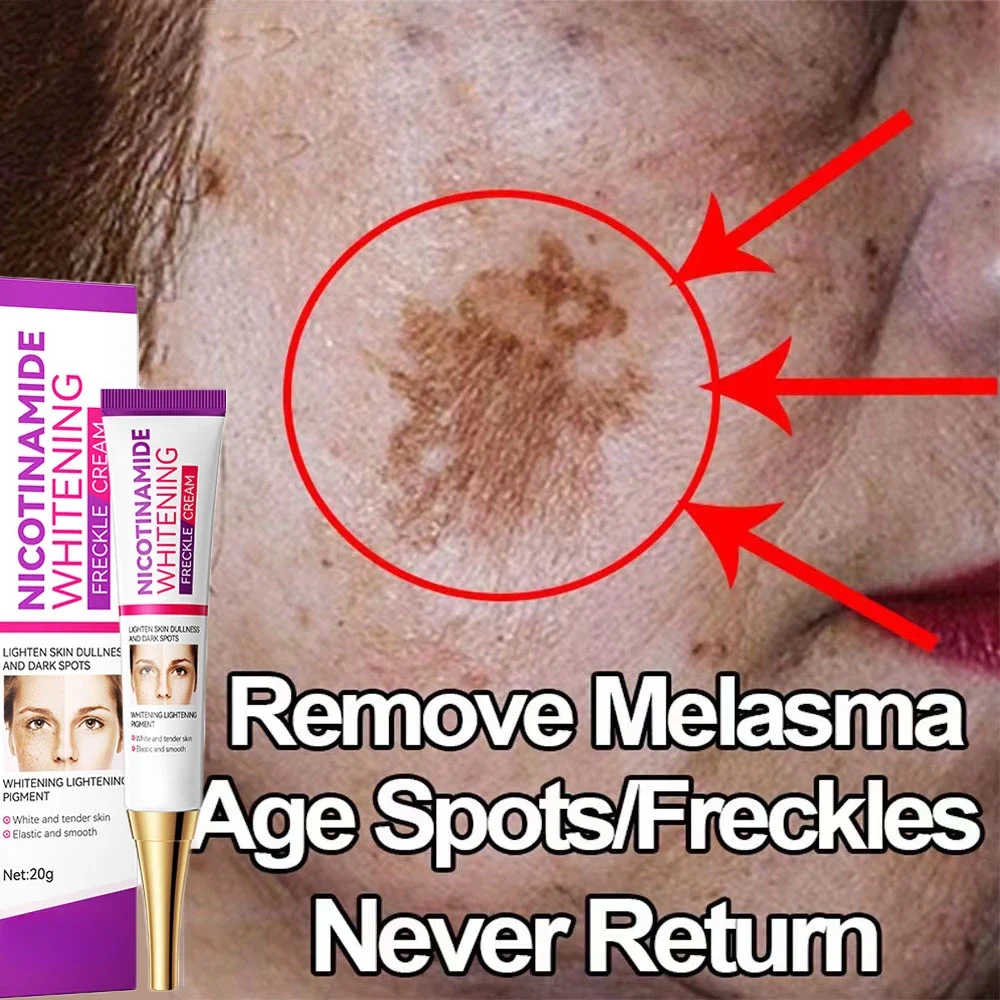 

Remove Melasma Whitening Freckles Cream Dark Spot Lightening Melanin Removal Melasma Remover Moisturize Brighten Face Skin Care